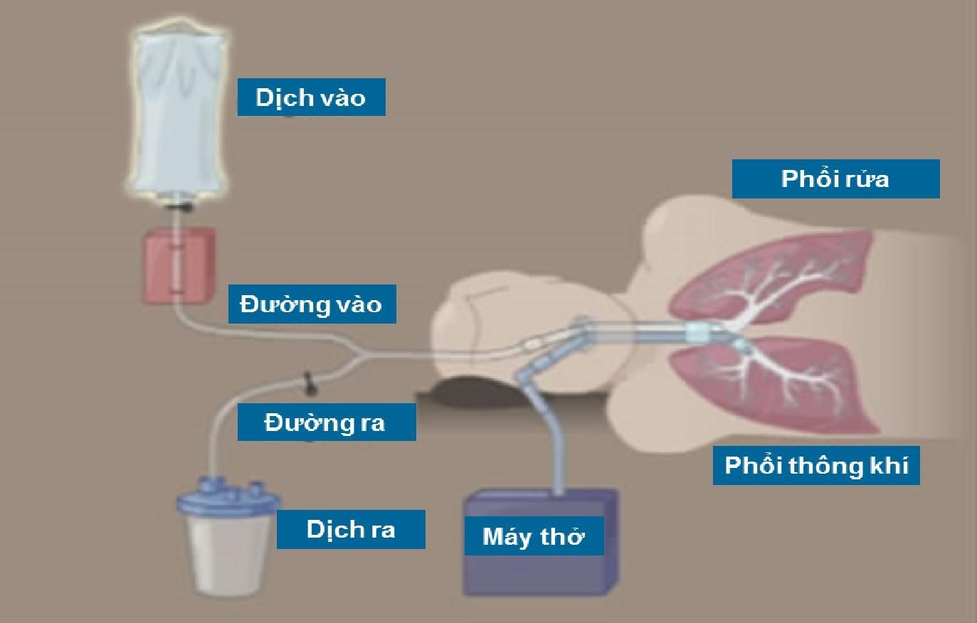 Thông tin về Rửa Phổi